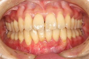 歯肉退縮の治療
