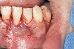 歯周病再生治療