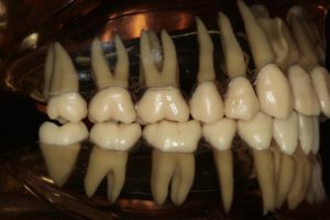 大臼歯の歯根
