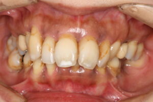 高度に進行した歯周病へのインプラント