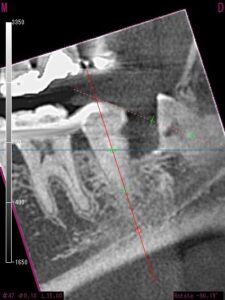 根管治療と歯周再生手術