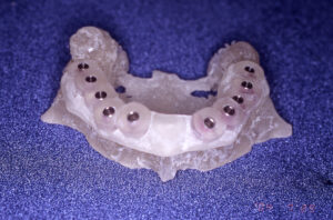 CTデータから作成したサージカルガイドと顎骨
