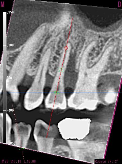 垂直性骨吸収の歯周再生治療