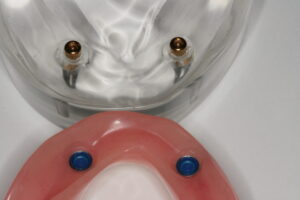 入れ歯を安定するインプラント