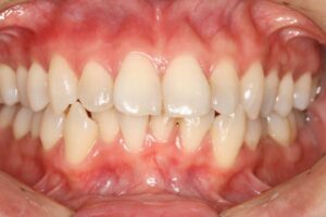 歯ぐきに黒追い着色がありますが、１週間ぐらいできれいになります。