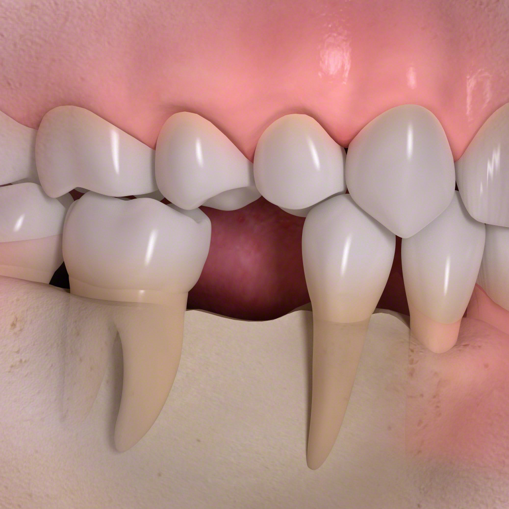 １本の歯の喪失