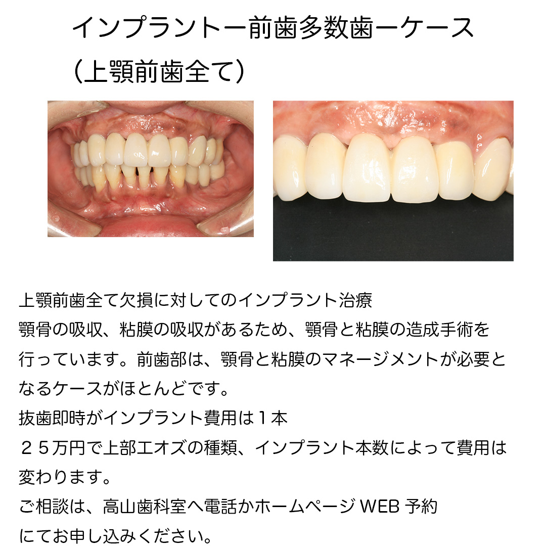 前歯部多数歯欠損ーインプラント
