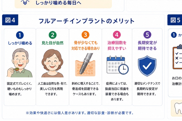 フルアーチインプラントのメリット