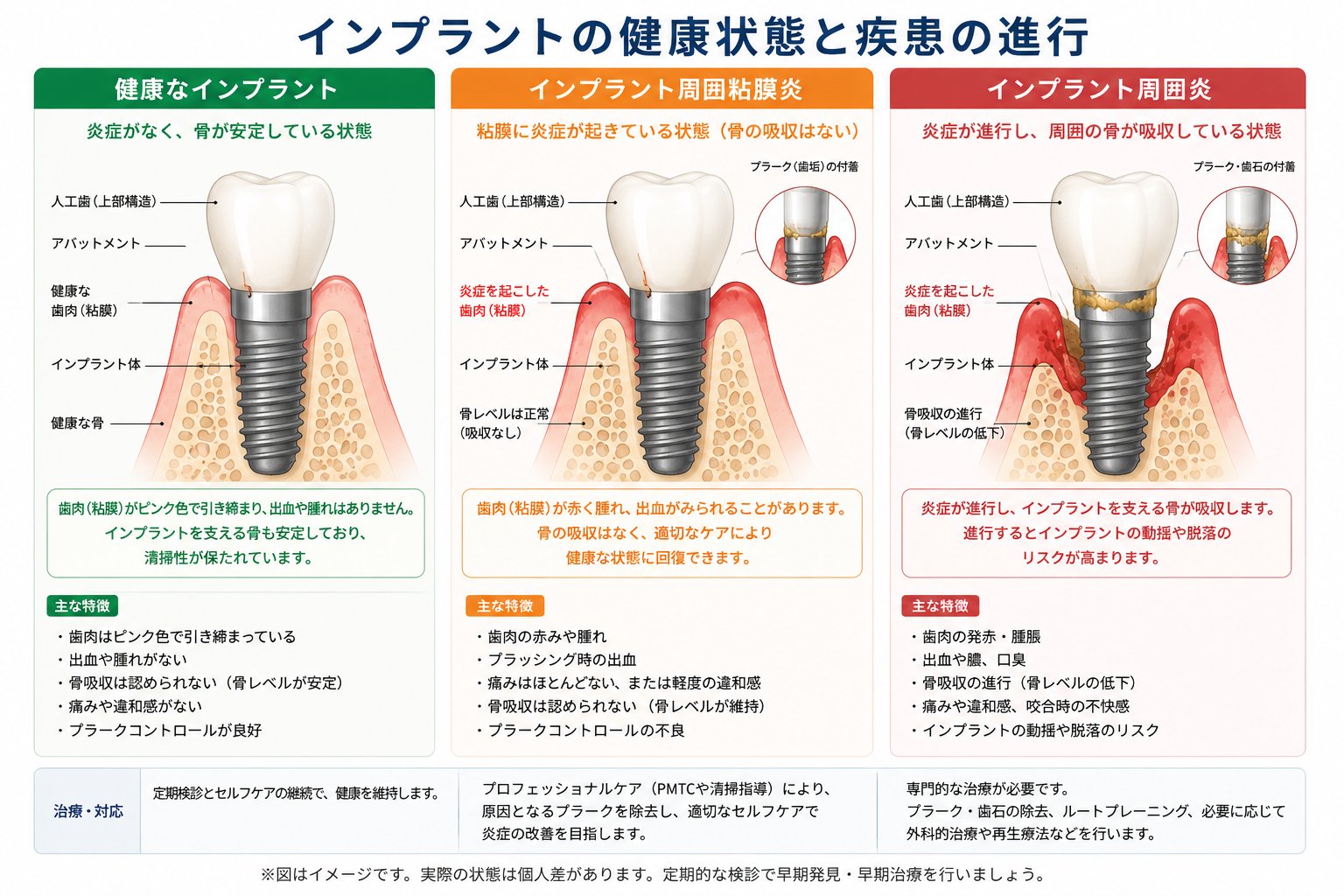 インプラントの健康状態と疾患の進行(健康・周囲粘膜炎・周囲炎)の特徴と治療｜高山歯科室