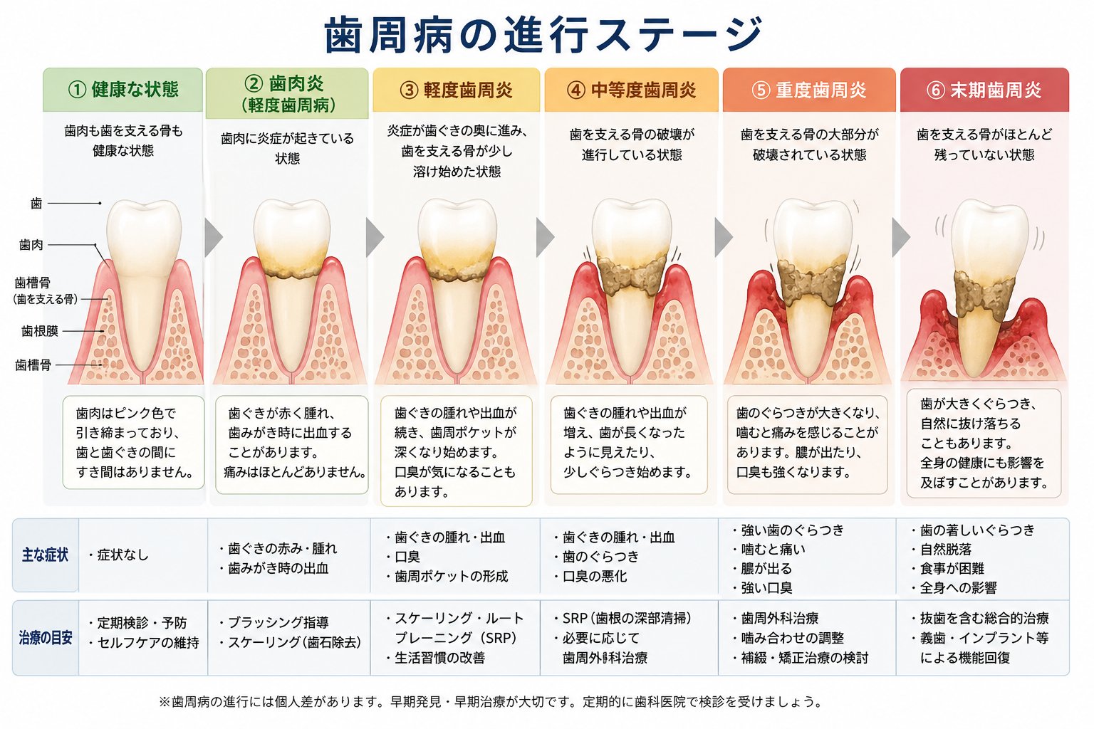 歯周病の進行ステージ6段階(健康・歯肉炎・軽度〜末期歯周炎)と症状・治療目安｜高山歯科室