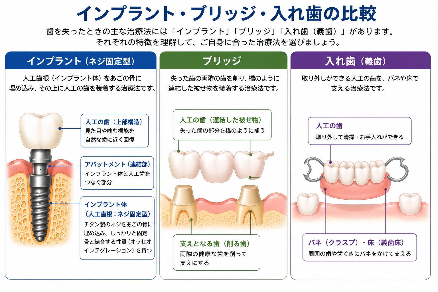 インプラント・ブリッジ・入れ歯の3つの治療法比較図｜高山歯科室