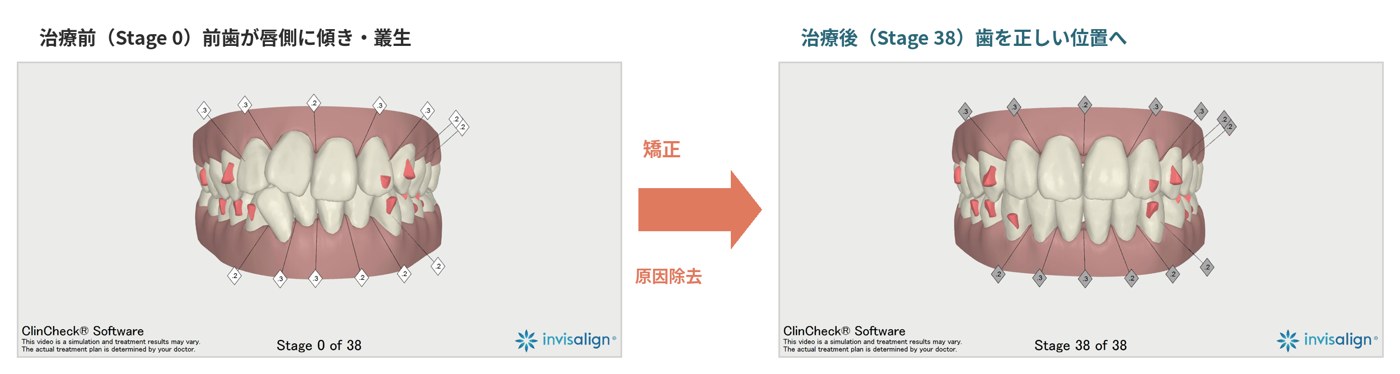 インビザラインの治療シミュレーション。治療前（Stage 0）は前歯が唇側に傾き叢生、治療後（Stage 38）は歯が正しい位置に整列