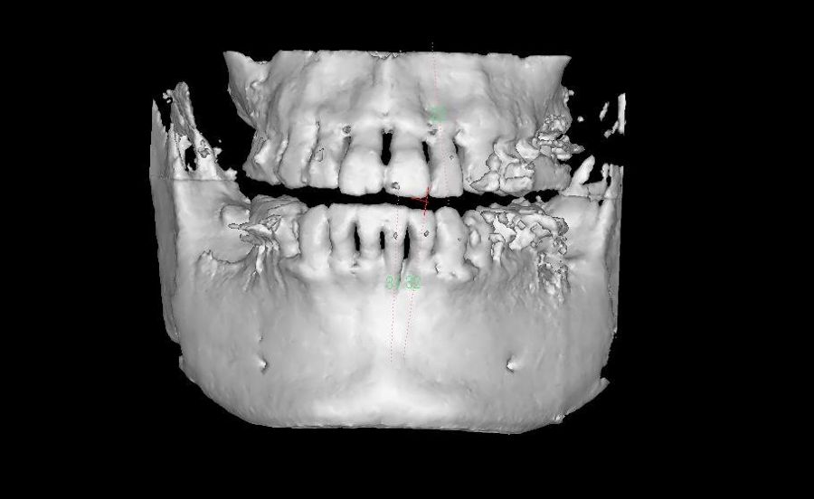 CT（3D）改善後：歯槽骨の状態が大きく回復している