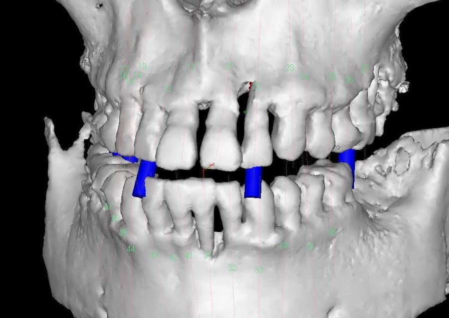 CT（3D・治療初期）：前歯部で歯槽骨が大きく吸収している