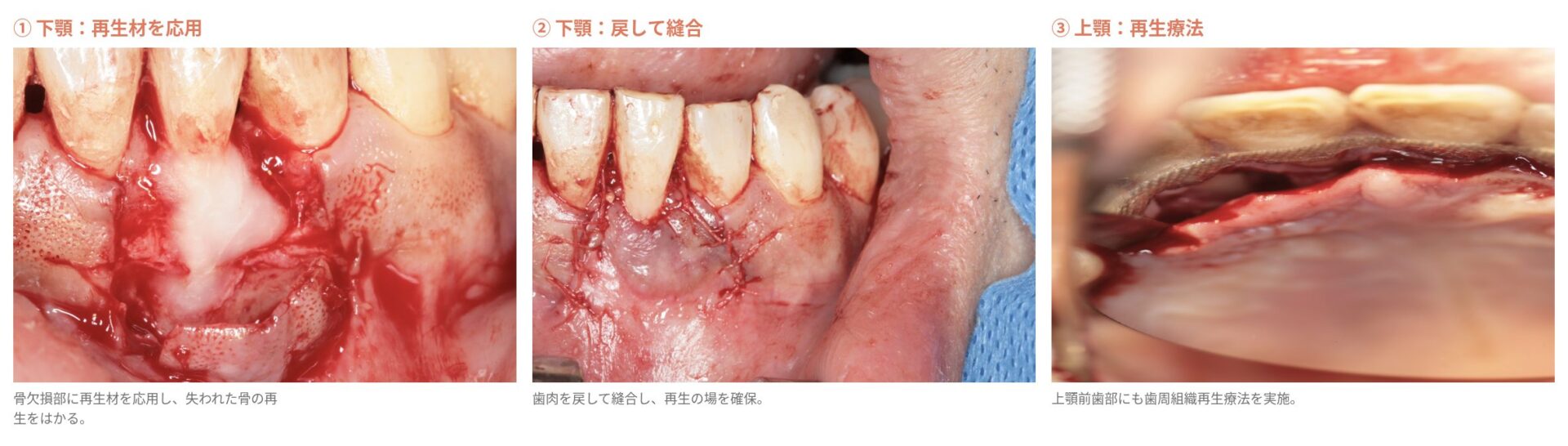歯周組織再生療法の流れ：①下顎に再生材を応用 ②下顎を縫合 ③上顎前歯部の再生療法