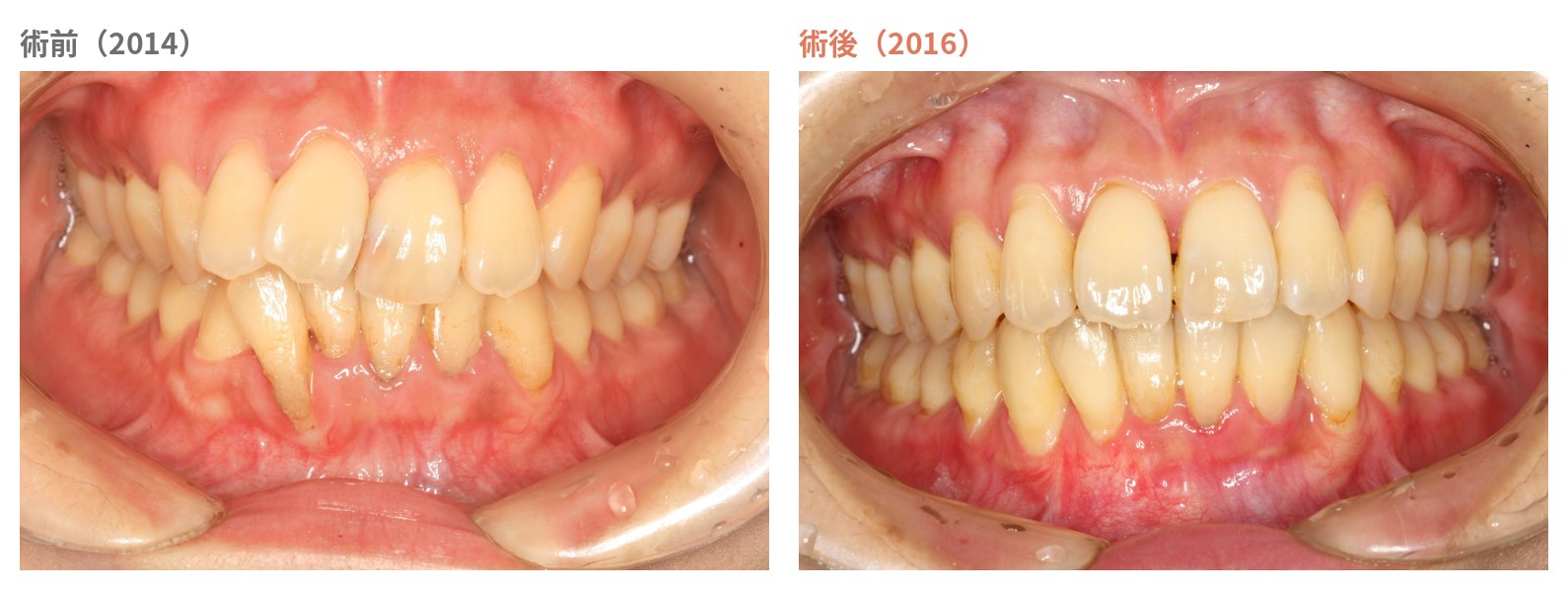 術前（2014年）と術後（2016年）の口腔内比較。下がっていた歯ぐきが回復し、露出していた根が覆われ、歯並びも整った
