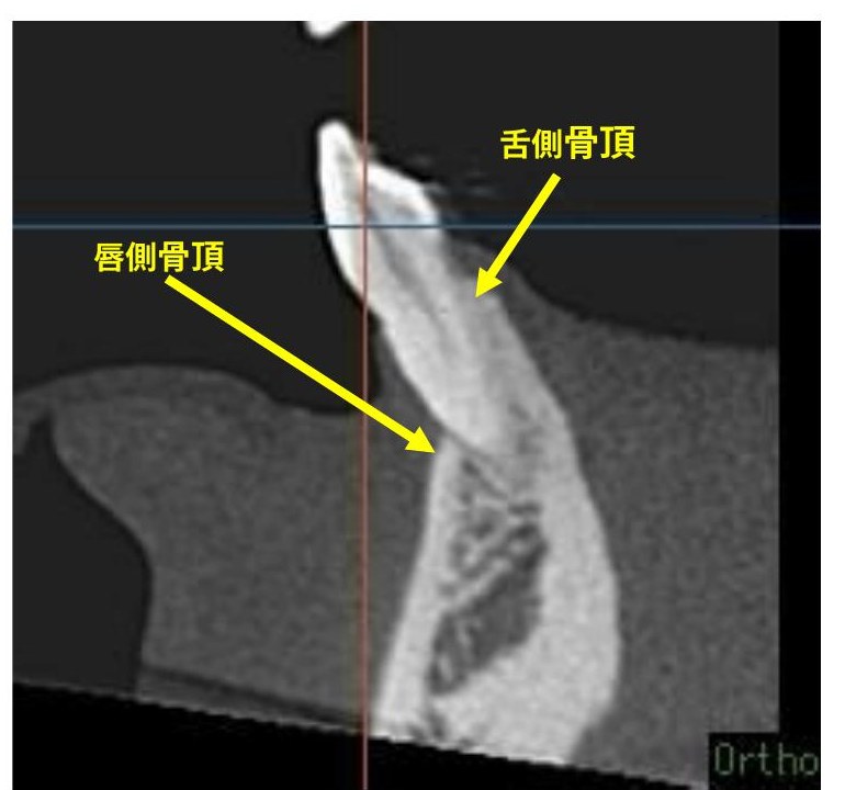CT断面：右下3番の唇側骨頂と舌側骨頂を示した画像。歯の外側（唇側）の骨が大きく失われている
